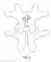 Fig. 03 - Facet joint fixation system