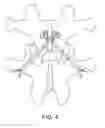 Fig. 05 - Facet joint fixation system