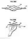 Fig. 27 - Methods and apparatus for orthopedic implants