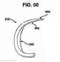 Fig. 41 - Methods and apparatus for orthopedic implants