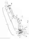 Fig. 02 - Method of implanting an acetabular shell