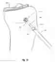 Fig. 22 - Methods and apparatus for forming a tunnel through a proximal end of a tibia