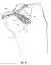 Fig. 23 - Methods and apparatus for forming a tunnel through a proximal end of a tibia