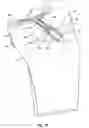Fig. 26 - Methods and apparatus for forming a tunnel through a proximal end of a tibia