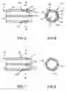 Fig. 03 - Splittable cannula having radiopaque marker