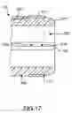 Fig. 07 - Splittable cannula having radiopaque marker