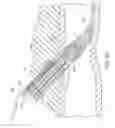 Fig. 20 - Device and method for suturing of internal puncture sites