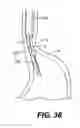 Fig. 25 - Devices and methods for tissue invagination