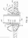 Fig. 17 - Devices and methods for performing a vascular anastomosis