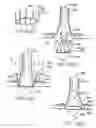 Fig. 52 - Devices and methods for performing a vascular anastomosis
