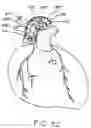 Fig. 62 - Devices and methods for performing a vascular anastomosis