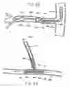 Fig. 63 - Devices and methods for performing a vascular anastomosis