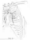 Fig. 66 - Devices and methods for performing a vascular anastomosis
