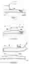 Fig. 02 - Arrangement and method for vascular anastomosis