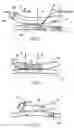 Fig. 03 - Arrangement and method for vascular anastomosis