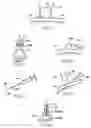 Fig. 05 - Arrangement and method for vascular anastomosis