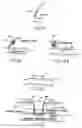 Fig. 09 - Arrangement and method for vascular anastomosis