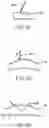 Fig. 10 - Arrangement and method for vascular anastomosis