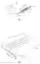 Fig. 02 - Microsurgical balloon with protective reinforcement