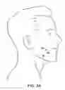 Fig. 03 - Dermal punch device