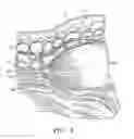 Fig. 04 - Method for surgical dissection, sizing and expansion
