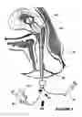 Fig. 08 - Cervical canal dilator
