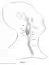 Fig. 12 - Vascular catheter with an expandable section and a distal tip for delivering a thromboembolic protection device and method of use
