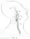 Fig. 13 - Vascular catheter with an expandable section and a distal tip for delivering a thromboembolic protection device and method of use