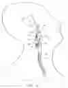 Fig. 14 - Vascular catheter with an expandable section and a distal tip for delivering a thromboembolic protection device and method of use
