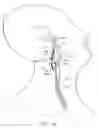 Fig. 15 - Vascular catheter with an expandable section and a distal tip for delivering a thromboembolic protection device and method of use