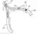 Fig. 01 - Devices and methods for preventing distal embolization using flow reversal in arteries having collateral blood flow
