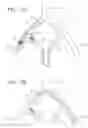Fig. 09 - Devices and methods for preventing distal embolization using flow reversal in arteries having collateral blood flow
