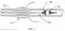 Fig. 02 - Temporary intraluminal filter guidewire and methods of use