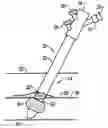 Fig. 01 - Systems and methods for sealing a vascular puncture