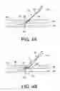 Fig. 06 - Apparatus and methods for delivering sealing materials during a percutaneous procedure to facilitate hemostasis