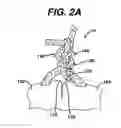 Fig. 04 - High strength suture with absorbable core