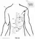 Fig. 02 - Gastric stimulation responsive to sensing feedback