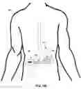 Fig. 03 - Gastric stimulation responsive to sensing feedback