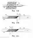 Fig. 08 - Method for treating neurovascular aneurysms