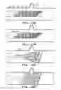 Fig. 09 - Method for treating neurovascular aneurysms