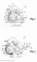 Fig. 02 - Body lumen device anchor, device and assembly