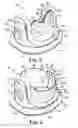 Fig. 03 - Bileaflet prosthetic valve and method of manufacture