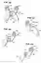 Fig. 17 - Facet arthroplasty devices and methods