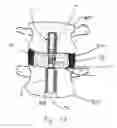 Fig. 19 - Spinal mobility preservation apparatus having an expandable membrane
