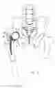 Fig. 03 - Knee prosthesis having a deformable articulation surface