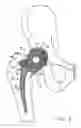 Fig. 04 - Knee prosthesis having a deformable articulation surface