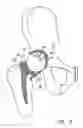 Fig. 06 - Knee prosthesis having a deformable articulation surface