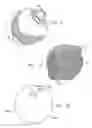 Fig. 07 - Knee prosthesis having a deformable articulation surface
