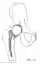 Fig. 08 - Knee prosthesis having a deformable articulation surface