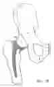 Fig. 09 - Knee prosthesis having a deformable articulation surface